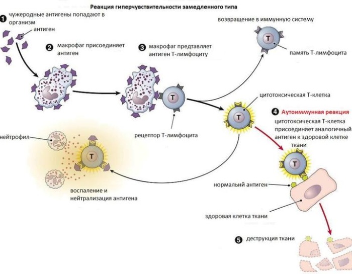 Аллергическая реакция замедленного типа. Типы, виды, стадии, лечение