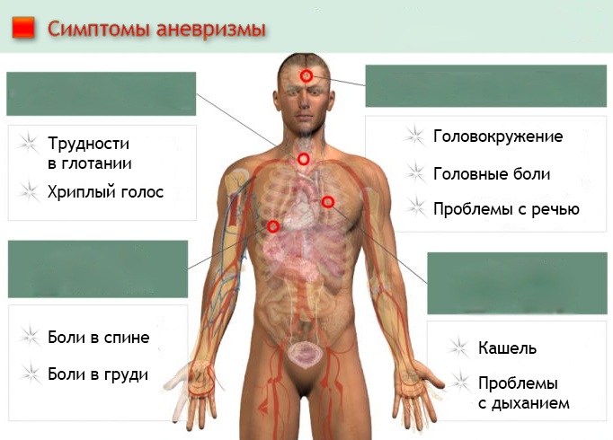 Аневризма брюшной аорты. Симптомы, УЗИ, признаки, диагностика, лечение без операции