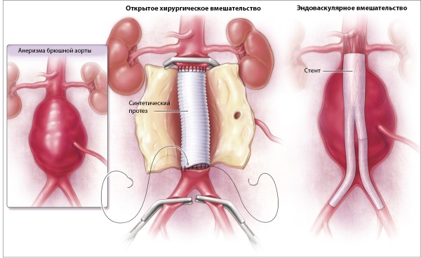 Аневризма брюшной аорты. Симптомы, УЗИ, признаки, диагностика, лечение без операции