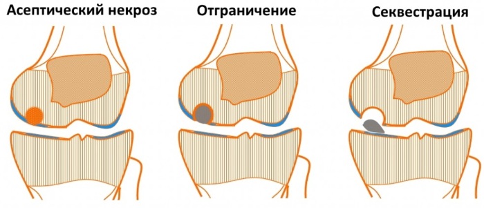 Болезнь Кенига коленного сустава. Что это такое, лечение, стадии у детей, спортсменов, взрослых, операция