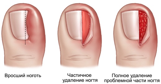 Болит палец на ноге большой. Причины, суставы, ногти, косточка, подушечки при ходьбе