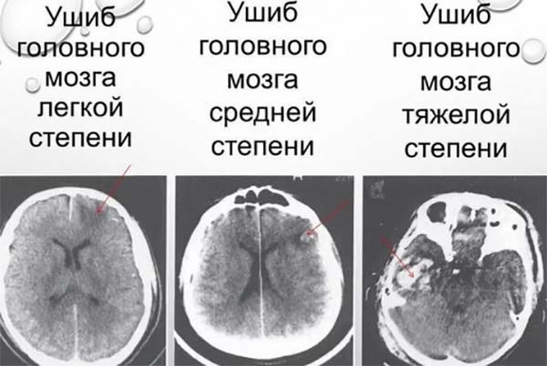 Черепно-мозговая травма. Что это такое, симптомы, первая помощь, последствия, классификация, лечение