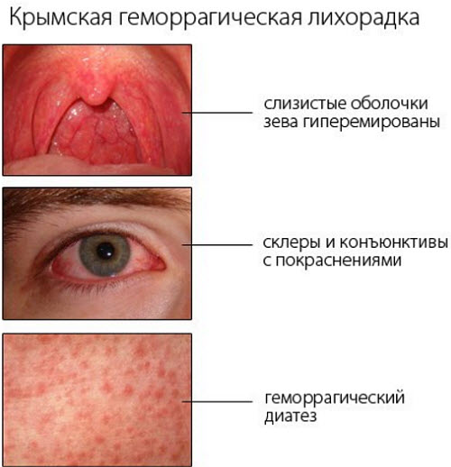 Геморрагическая лихорадка. Симптомы с почечным синдромом, что это такое, лечение