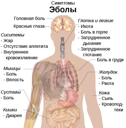 Геморрагическая лихорадка. Симптомы с почечным синдромом, что это такое, лечение