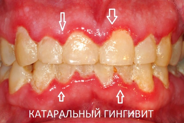 Гингивит у детей лечение фото