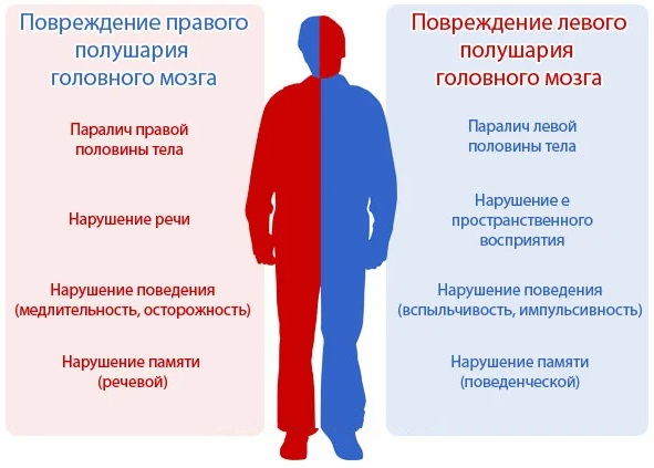 Ишемический инсульт. Последствия, неврология, лечение у взрослых, пожилых, детей, диагностика, восстановление