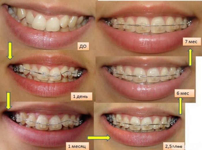 Как меняется лицо после исправления прикуса фото до и после