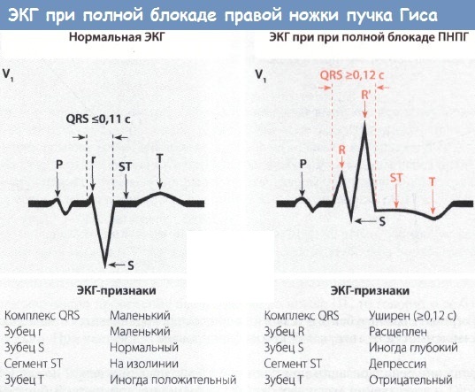 Нарушение внутрижелудочковой проводимости на ЭКГ у ребенка, подростка, взрослых. Что это значит