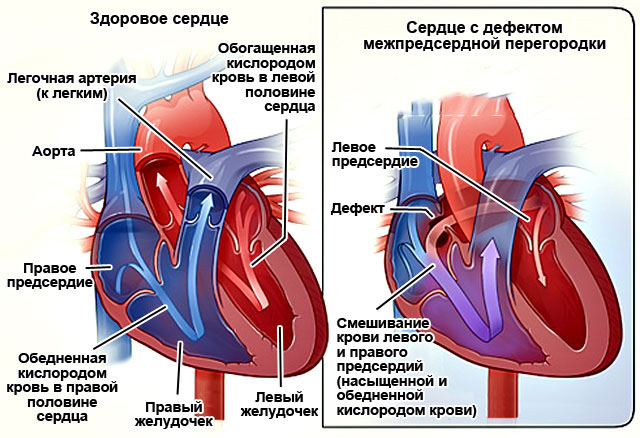 Нарушение внутрижелудочковой проводимости на ЭКГ у ребенка, подростка, взрослых. Что это значит