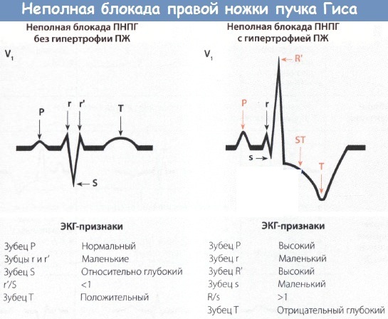 Нарушение внутрижелудочковой проводимости на ЭКГ у ребенка, подростка, взрослых. Что это значит