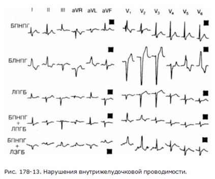 Нарушение внутрижелудочковой проводимости на ЭКГ у ребенка, подростка, взрослых. Что это значит