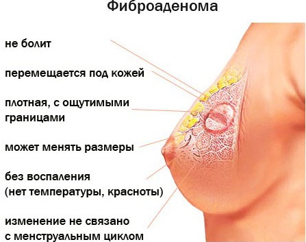 Уплотнения в грудных железах у женщин. Что это может быть перед месячными, беременности, что делать