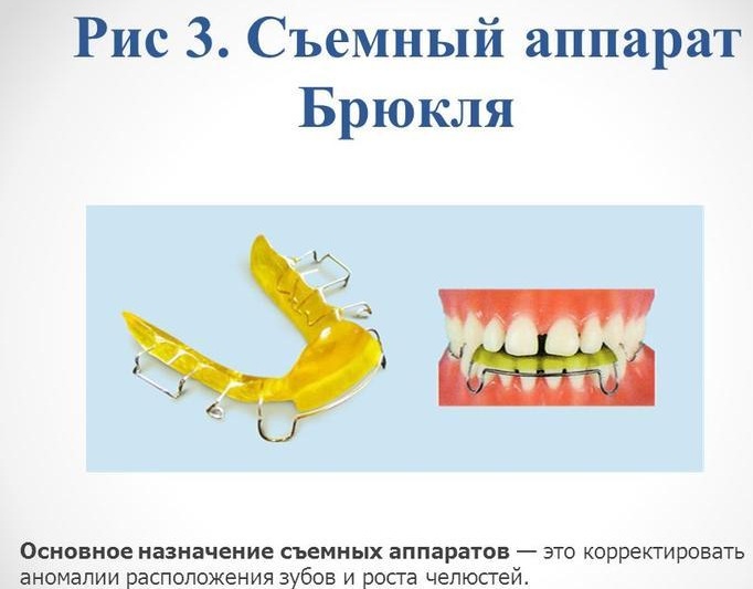 Пластинка детская ортодонтическая фото