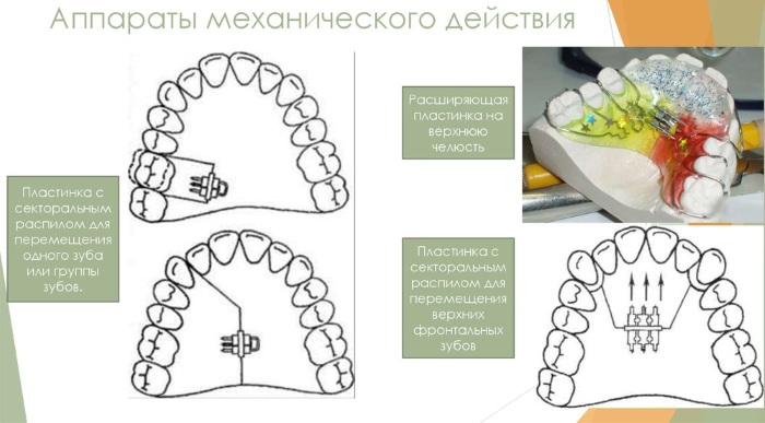 Ортодонтическая пластинка для детей. Классификация и виды, цены