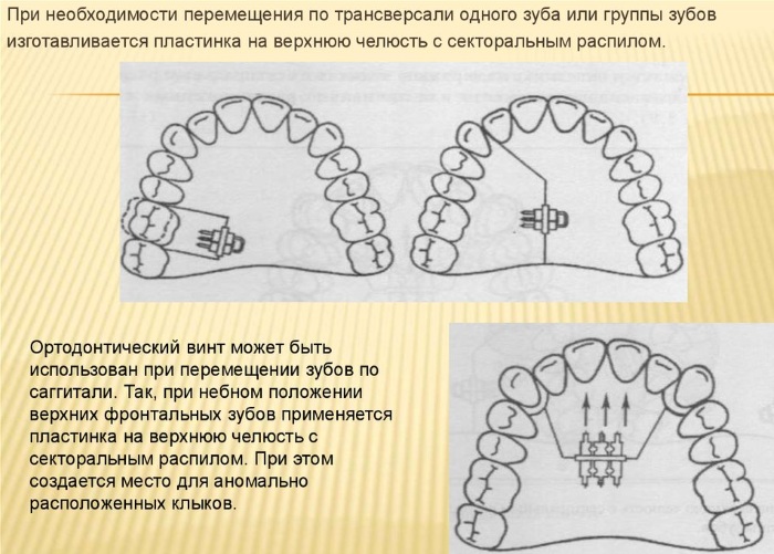 Ортодонтическая пластинка для детей. Классификация и виды, цены