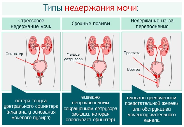 При чихании выделяется моча. Что делать, причины, лечение у женщин, мужчин, к какому врачу обратиться