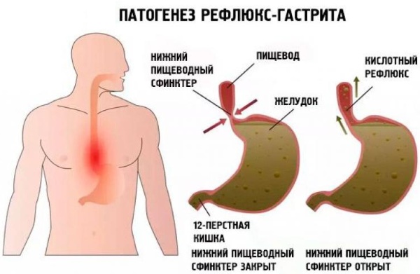 Рефлюкс-гастрит. Симптомы и лечение, диета, народные средства