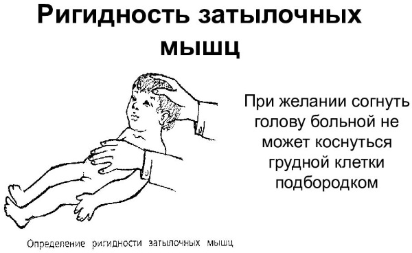 Ригидность затылочных мышц. Что это, как определить у детей, взрослых, причины, лечение