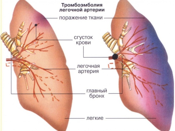 Тромбоэмболия. Симптомы и признаки, прогноз для жизни, диагностика, лечение, профилактика