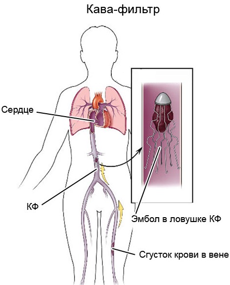 Тромбоэмболия. Симптомы и признаки, прогноз для жизни, диагностика, лечение, профилактика