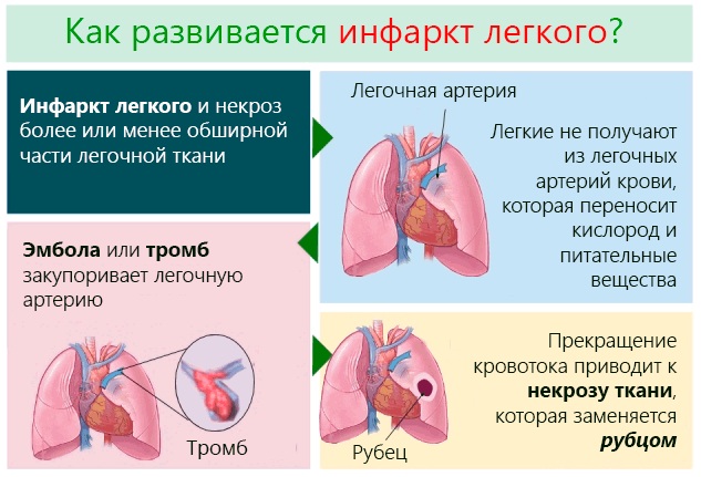 Тромбоэмболия. Симптомы и признаки, прогноз для жизни, диагностика, лечение, профилактика