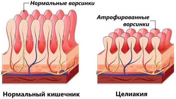 Болезни кишечника у мужчин. Симптомы, признаки