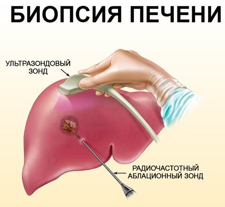 Цирроз печени. Симптомы у женщин, мужчин, диагностика, причины, лечение препаратами