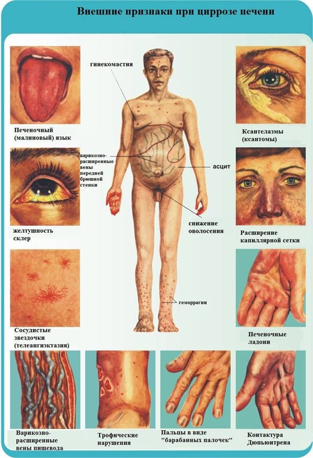 Цирроз печени. Симптомы у женщин, мужчин, диагностика, причины, лечение препаратами