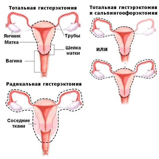 Удаление яичников, шейки матки. Последствия для организма при миоме, опущении, эндометриозе, название, сколько длится операция, цена