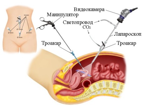 Удаление яичников, шейки матки. Последствия для организма при миоме, опущении, эндометриозе, название, сколько длится операция, цена