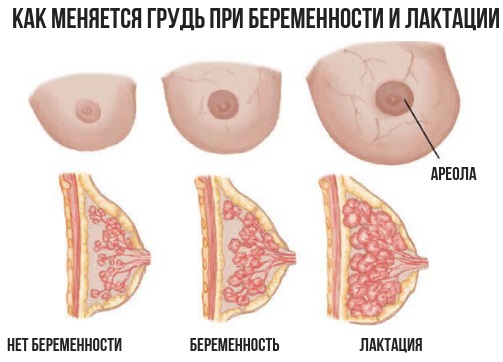 Уплотнения в грудных железах у женщин. Что это может быть перед месячными, беременности, что делать