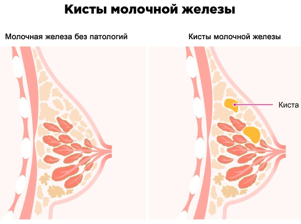 Уплотнения в грудных железах у женщин. Что это может быть перед месячными, беременности, что делать