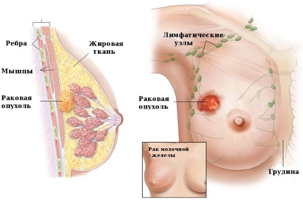 Уплотнения в грудных железах у женщин. Что это может быть перед месячными, беременности, что делать