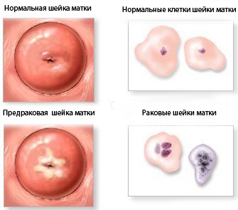 Жидкостная цитология шейки матки. Что это такое, расшифровка результатов, таблица, как берется, что показывает