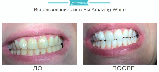 Amazing White отбеливание. Отзывы, что это такое, где купить, фото до и после