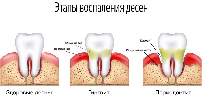 Amway Glister (Амвей Глистер) ополаскиватель для рта. Инструкция по применению, цена