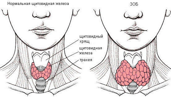 АТ-ТГ сильно повышен. Что это значит, симптомы, причины, лечение