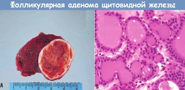 АТ-ТГ сильно повышен. Что это значит, симптомы, причины, лечение