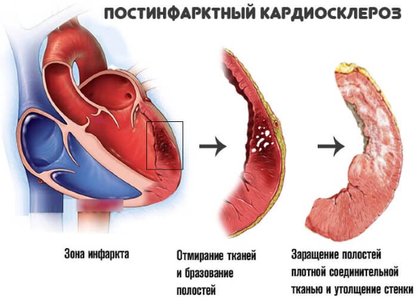 Атеросклеротический кардиосклероз. Что это такое, симптомы, лечение