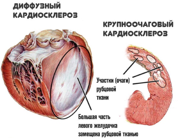 Атеросклеротический кардиосклероз. Что это такое, симптомы, лечение