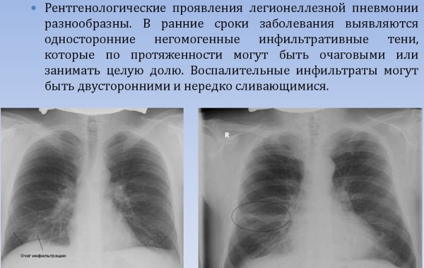 Атипичная пневмония картинки