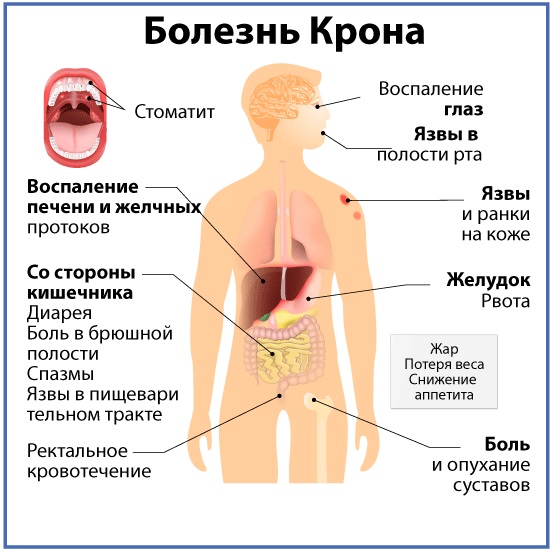 Болезнь Крона. Симптомы и лечение, что это такое, классификация, клинические рекомендации