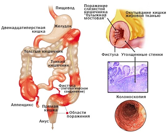 Болезнь Крона. Симптомы и лечение, что это такое, классификация, клинические рекомендации
