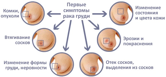 Болит грудь перед месячными, сильно набухает. Почему, что делать