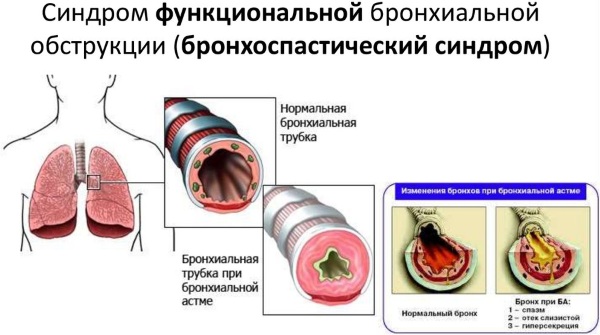 Бронхоспазм. Симптомы у детей, взрослых, что это такое, причины, как снять, лечение