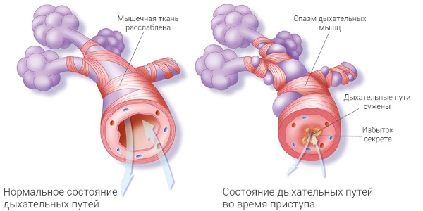 Бронхоспазм. Симптомы у детей, взрослых, что это такое, причины, как снять, лечение