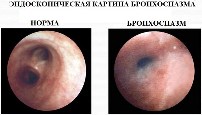 Бронхоспазм. Симптомы у детей, взрослых, что это такое, причины, как снять, лечение