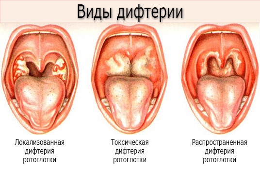 Дифтерия у детей. Симптомы, профилактика, пути передачи, лечение