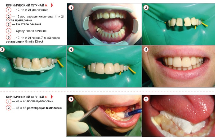 Эстетическая реставрация зуба Gradia GC Япония компониром, виниром. Это как, что такое с установкой стекловолоконного штифта. Фото до и после
