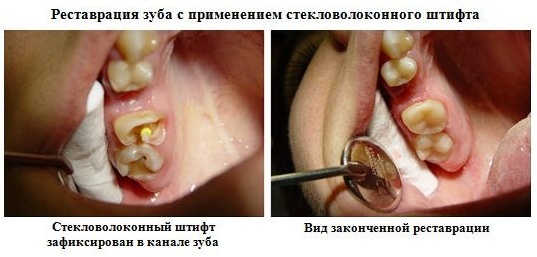 Эстетическая реставрация зуба Gradia GC Япония компониром, виниром. Это как, что такое с установкой стекловолоконного штифта. Фото до и после